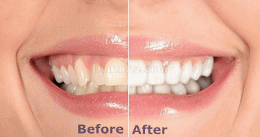 Prooral®4001家庭用・歯科用ホワイトニング装置