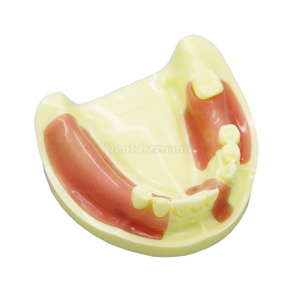 歯科下顎義歯インプラント研究練習用模型 道具 標準教学道具 イエローベース