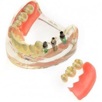 JX®M6006歯科インプラント歯模型