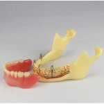 JX®歯科インプラント歯模型M2014b