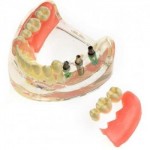 JX®M6006歯科インプラント歯模型