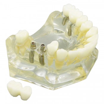 歯科上顎インプラント治療説明用模型モデル 4本釘 脱着可能 クリアベース 透明