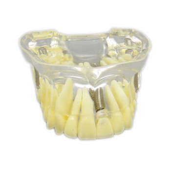 歯科上顎治療説明用インプラントモデル模型歯列研究用教学模型 脱着可能 4本釘 クリアベース 透明