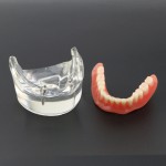 歯科下顎重塁教学用義歯モデル模型 2本インプラント6002 01