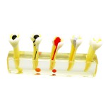 高品質歯科虫歯治療説明用モデル虫歯5段階拡大展示用模型脱着可能歯列模型 クリアベース