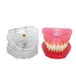 歯科研究治療説明用上下顎義歯模型 高品質脱着可能歯列模型 実用的 クリアベース ピンク