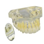 歯科上顎インプラント治療説明用模型モデル 4本釘 脱着可能 クリアベース 透明