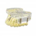 歯科上顎治療説明用インプラントモデル模型歯列研究用教学模型 脱着可能 4本釘 クリアベース 透明