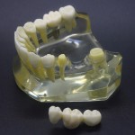 1:1 歯科下顎インプラントモデル　インプラント、ブリッジ付き2010