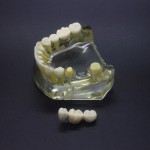 1:1 歯科下顎インプラントモデル　インプラント、ブリッジ付き2010