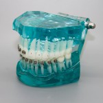 歯科矯正治療モデル金属セラミック舌側ブラケット付き3009