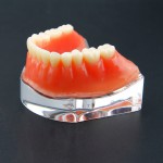 歯科用オーバーデンチャー歯モデル下顎精密インプラントモデル金色