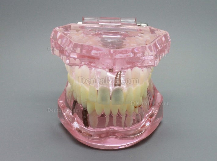 歯科インプラント解析デモ歯症モデルピンク