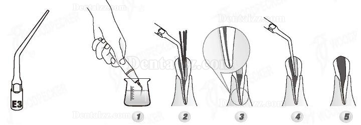 Woodpecker® ED3 DTE根管治療用チップ(SATELECと交換、5本入)