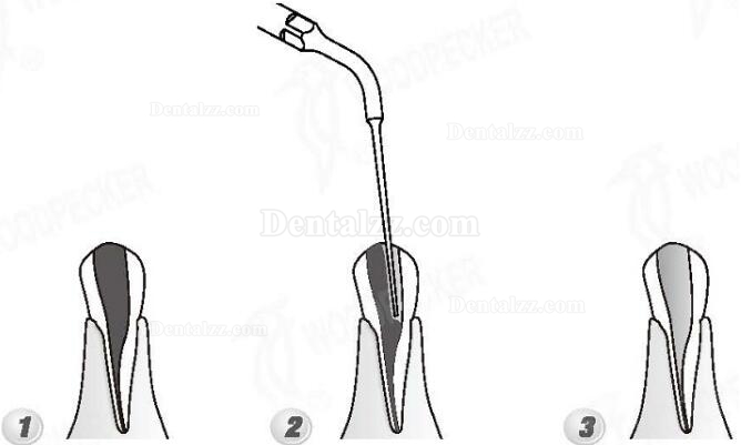 Woodpecker® ED4 DTE根管治療用チップ(SATELECと交換、5本入)