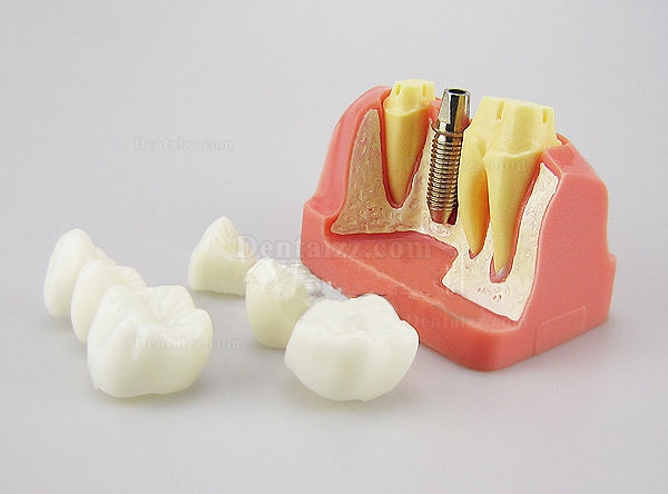 JX®歯科インプラント・クラウン歯模型M2017