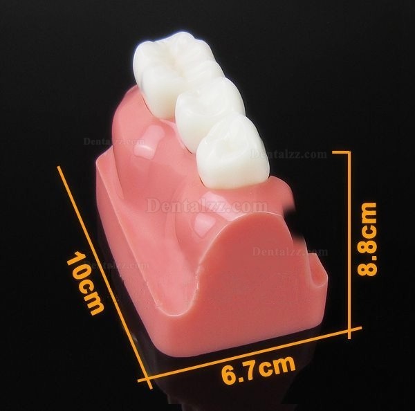 JX®歯科インプラント・クラウン歯模型M2017