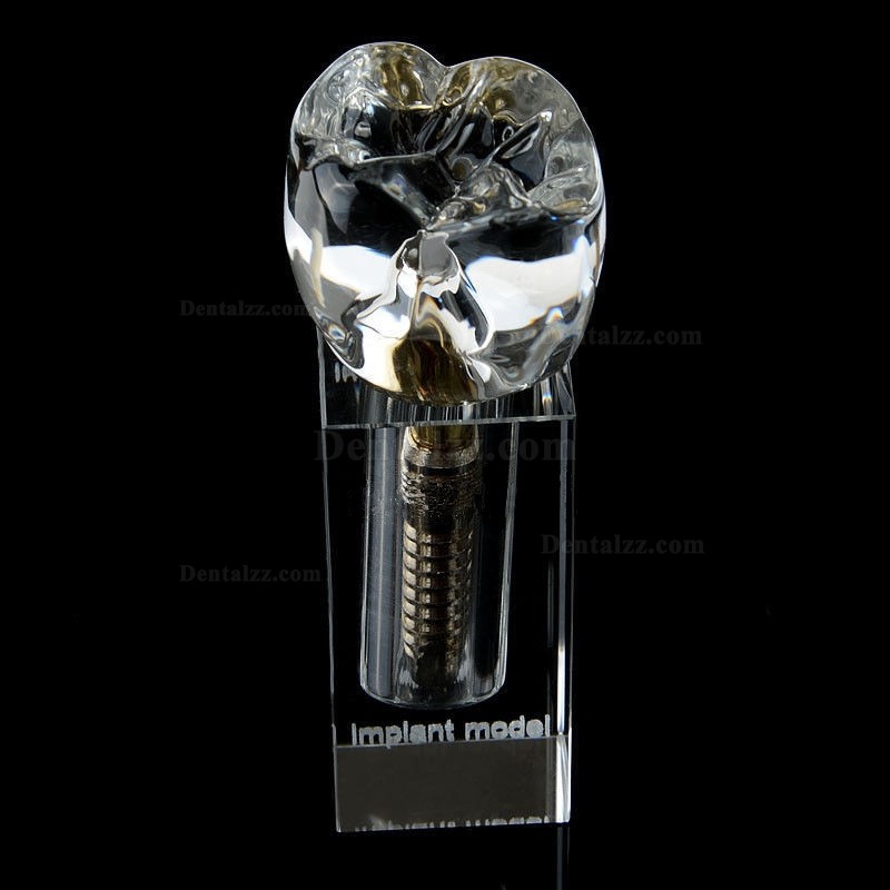 JX®歯科インプラント・クリスタル歯模型M2019-II