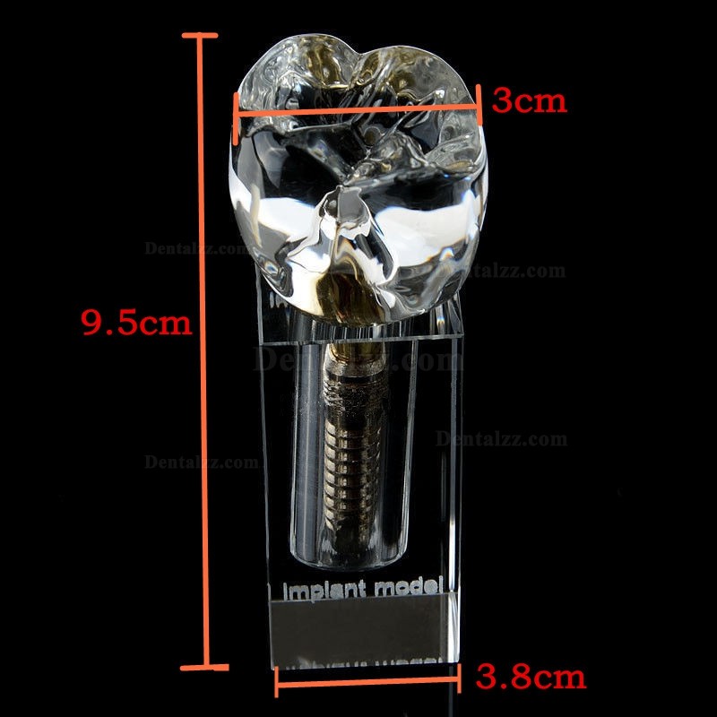 JX®歯科インプラント・クリスタル歯模型M2019-II
