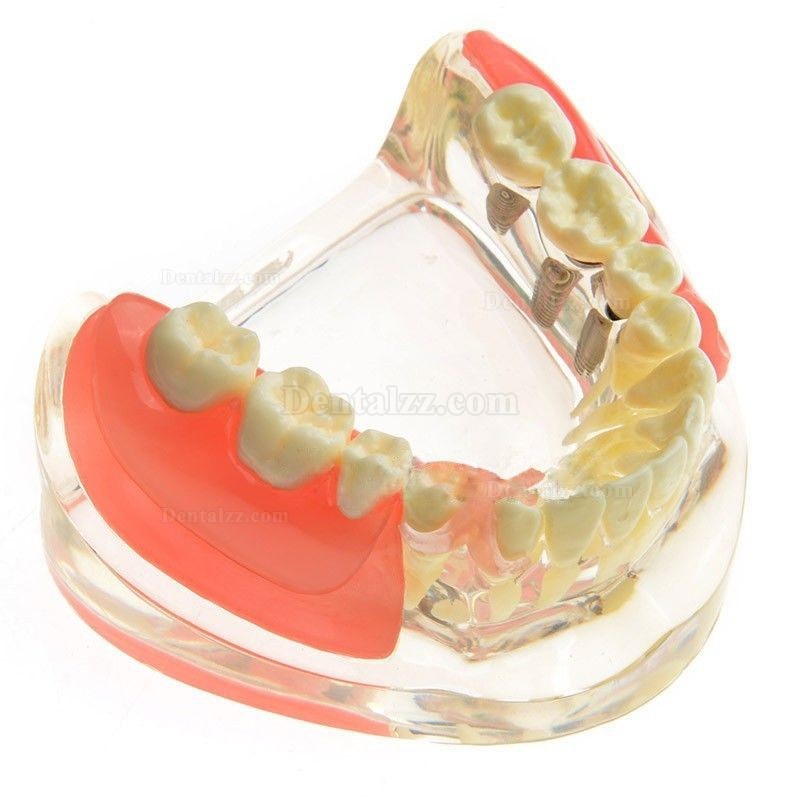 JX®歯科インプラント歯模型M6006