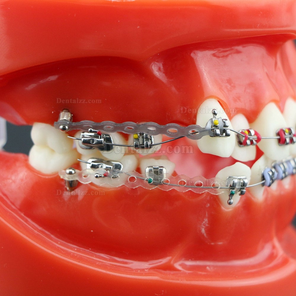 歯列矯正モデル 模型 歯科 矯正治療説明用 研究用モデル 金属ブラケット アーチワイヤーチェーン付き