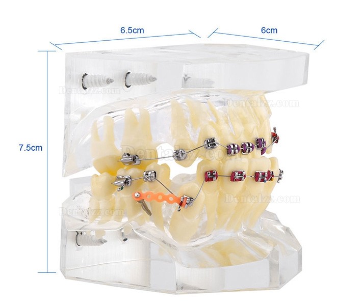 歯科矯正治療不正咬合モデルブラケット・チェーン・ワイヤー付き