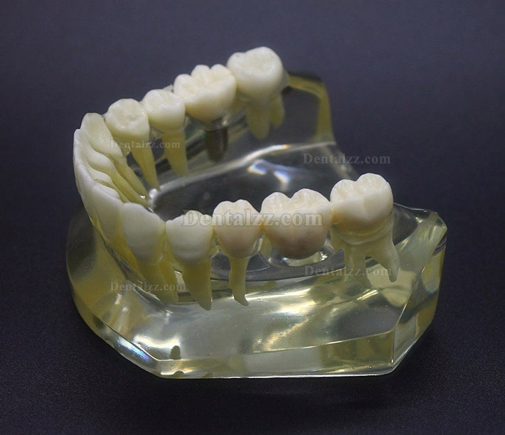 歯科教学インプラントTypodont モデル下顎クラウン橋2010