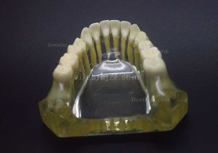 歯科教学インプラントTypodont モデル下顎クラウン橋2010