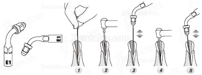 Woodpecker® E1 UDSシリーズ根管治療用チップ(EMSと交換.5本入)