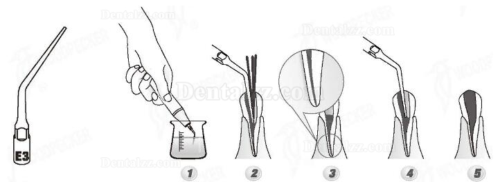 Woodpecker® E3 UDSシリーズ根管治療用チップ(EMSと交換、5本入)