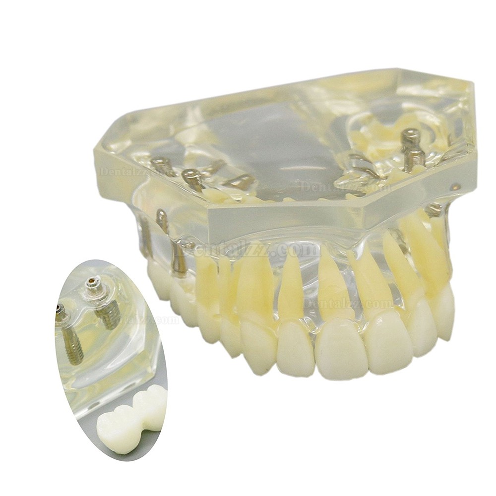 歯科上顎インプラント治療説明用模型モデル 4本釘 脱着可能 クリアベース 透明