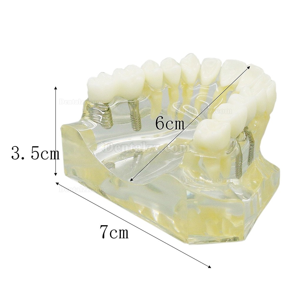 歯科上顎インプラント治療説明用模型モデル 4本釘 脱着可能 クリアベース 透明