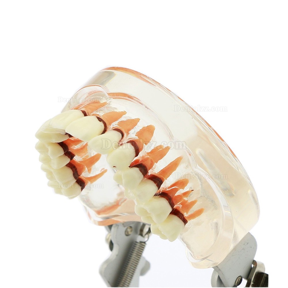 歯科治療説明用歯周萎縮模型 研究用上下顎開閉式歯結石模型歯列疾患モデル クリアベース