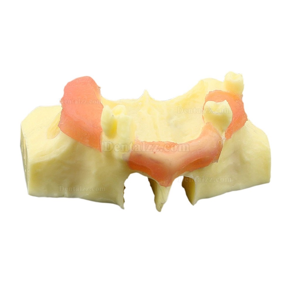 歯科上顎洞底挙上術練習用模型 サイナスリフト ソケットリフト 治療説明用 イエローベース