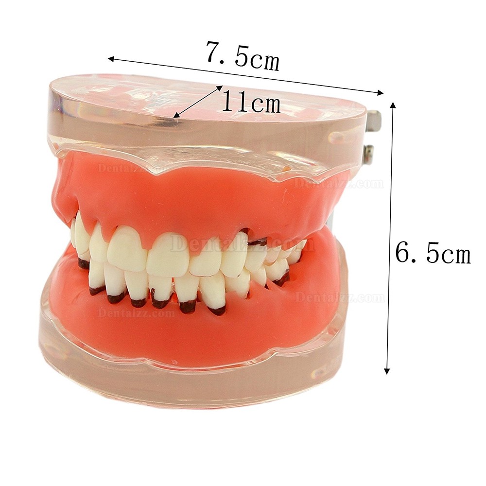 歯科治療説明用歯周萎縮模型 研究用上下顎開閉式歯結石模型歯列疾患モデル クリアベース
