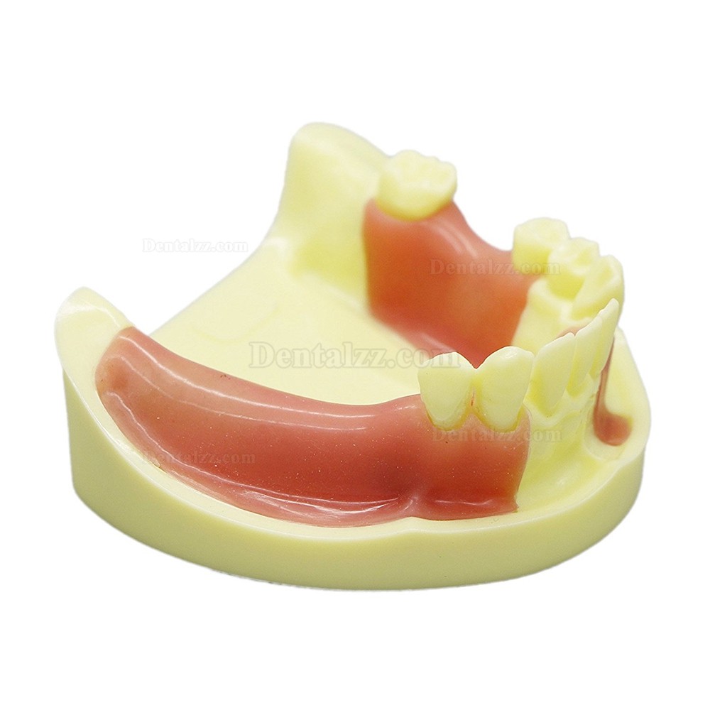 歯科下顎義歯インプラント研究練習用模型 道具 標準教学道具 イエローベース