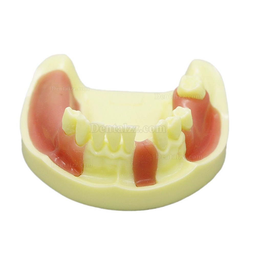 歯科下顎義歯インプラント研究練習用模型 道具 標準教学道具 イエローベース