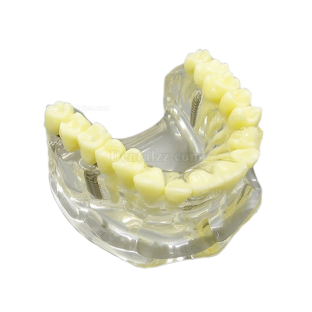 歯科上顎治療説明用インプラントモデル模型歯列研究用教学模型 脱着可能 4本釘 クリアベース 透明