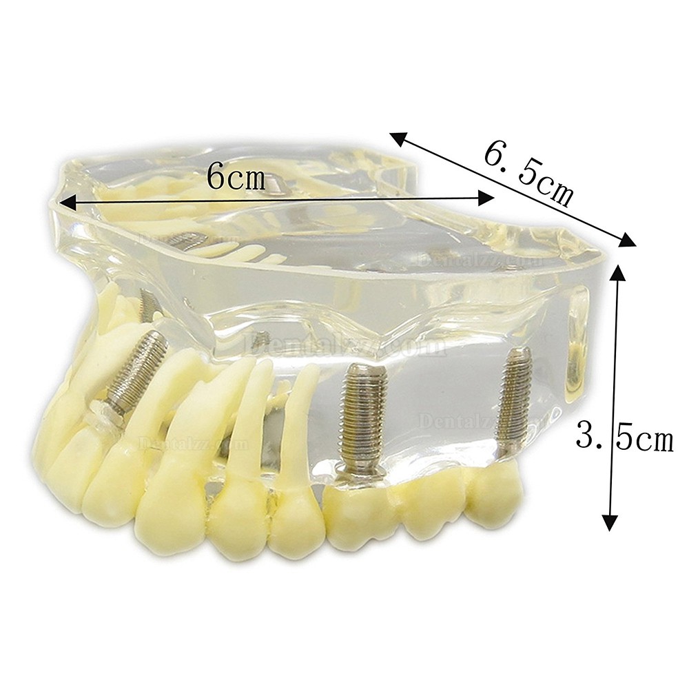 歯科上顎治療説明用インプラントモデル模型歯列研究用教学模型 脱着可能 4本釘 クリアベース 透明