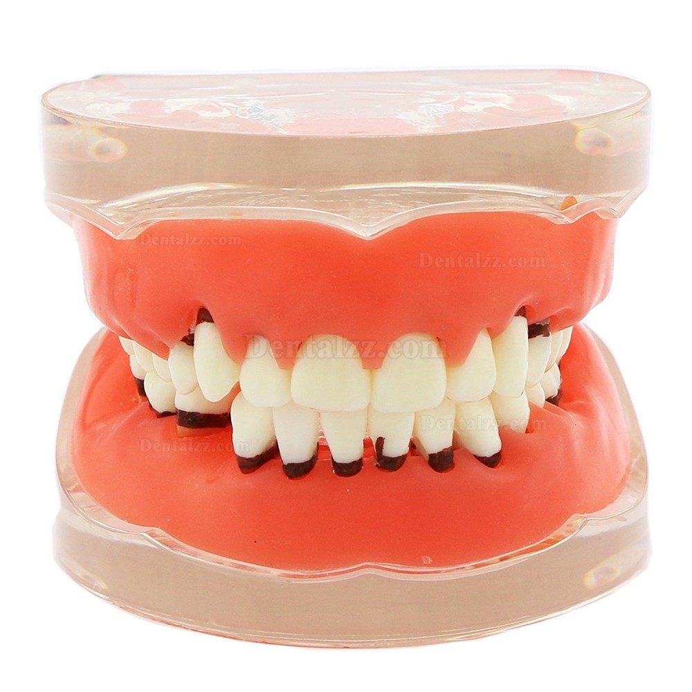 歯科治療説明用歯周萎縮模型 研究用上下顎開閉式歯結石模型歯列疾患モデル クリアベース