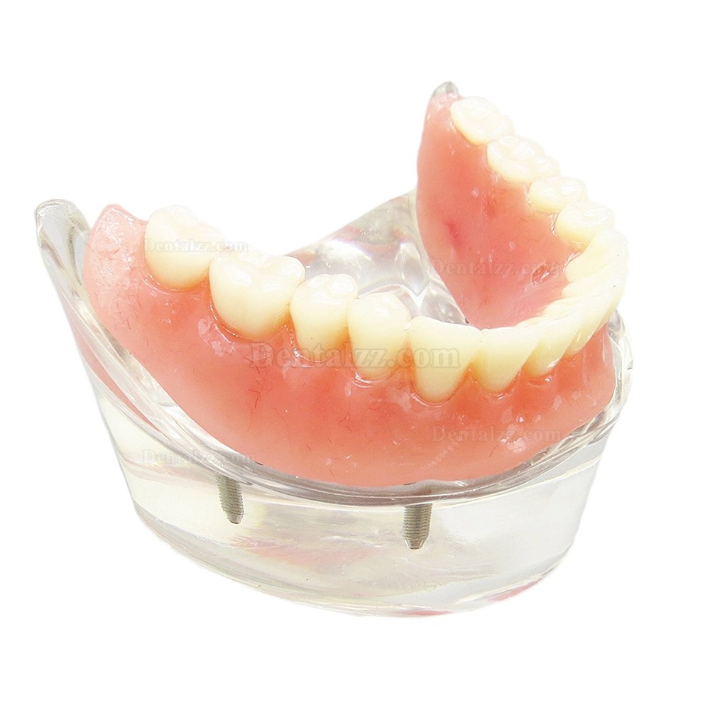 歯科下顎インプラント用義歯モデル模型 研究治療説明用歯科模型 4本釘 脱着可能 クリアベース 透明