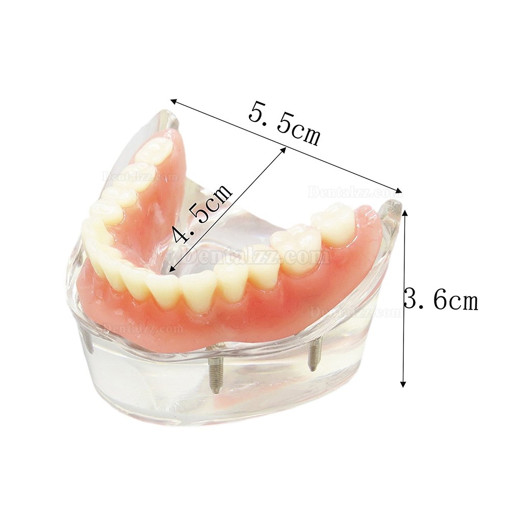 歯科下顎インプラント用義歯モデル模型 研究治療説明用歯科模型 4本釘 脱着可能 クリアベース 透明