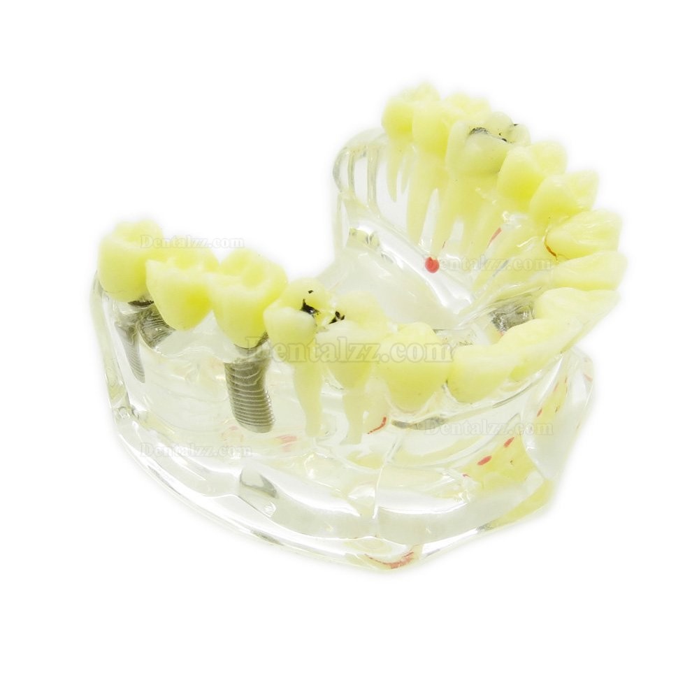 歯科治療説明用虫歯付きの上顎模型 歯科透明インプラントモデル模型 脱着可能