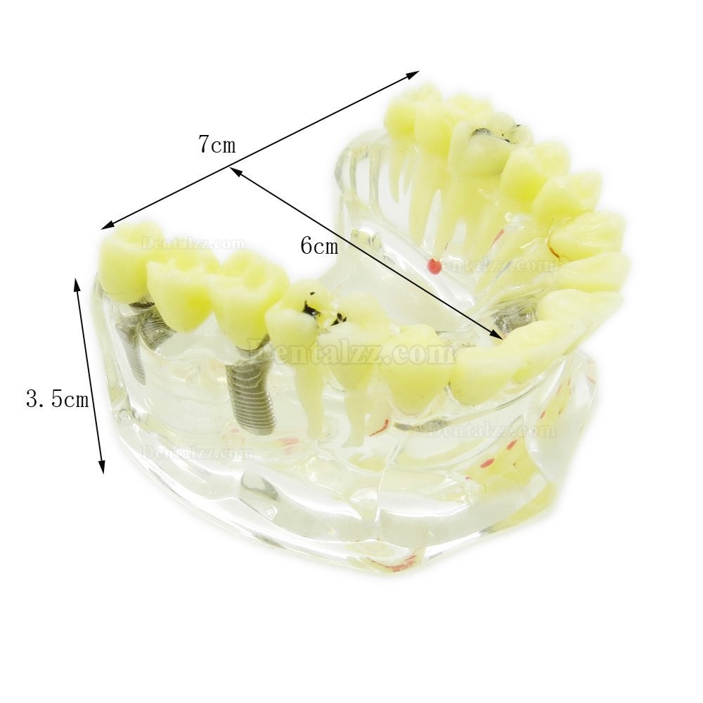 歯科治療説明用虫歯付きの上顎模型 歯科透明インプラントモデル模型 脱着可能
