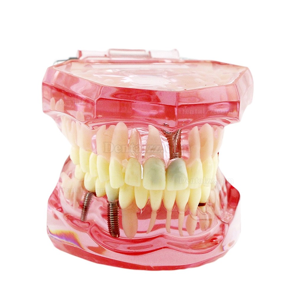 歯の構造虫歯研究治療用模型 上下顎180度開閉式インプラント歯列モデル模型 ピンク