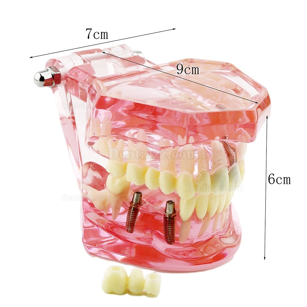 歯の構造虫歯研究治療用模型 上下顎180度開閉式インプラント歯列モデル模型 ピンク