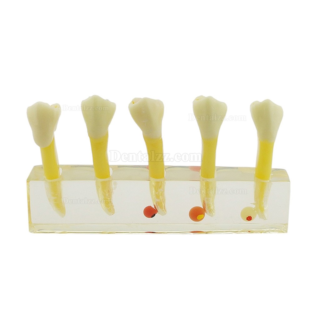 高品質歯科虫歯治療説明用モデル虫歯5段階拡大展示用模型脱着可能歯列模型 クリアベース 