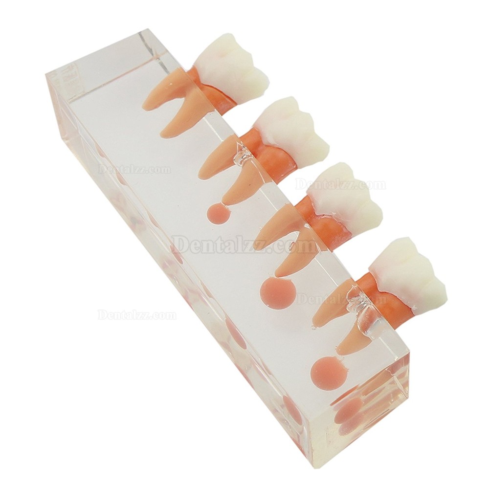 歯科虫歯歯髄炎治療説明用歯列模型 高品質透明虫歯拡大モデル