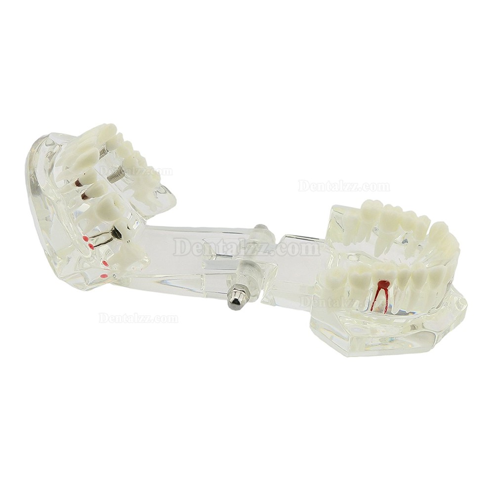 虫歯治療説明用透明歯列模型 歯科上下顎180度開閉式インプラントモデル模型