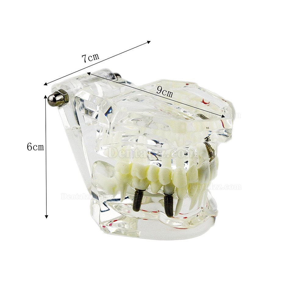 虫歯治療説明用透明歯列模型 歯科上下顎180度開閉式インプラントモデル模型